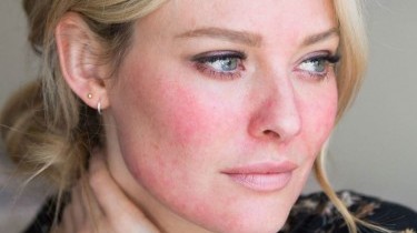 Acne Rosacea: i migliori rimedi omeopatici