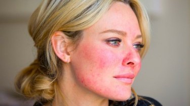 Acne Rosacea: i migliori rimedi naturali