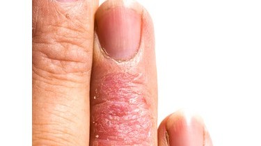 I migliori rimedi per le dermatiti