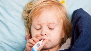 Morbillo: nel 2017 già superati 1000 casi