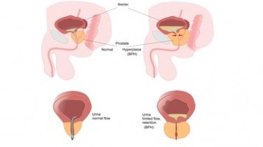 Prostatite: il ruolo dello zinco