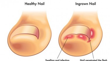 Come curare l'unghia incarnita?